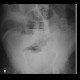 Large bowel ileus: X-ray - Plain radiograph